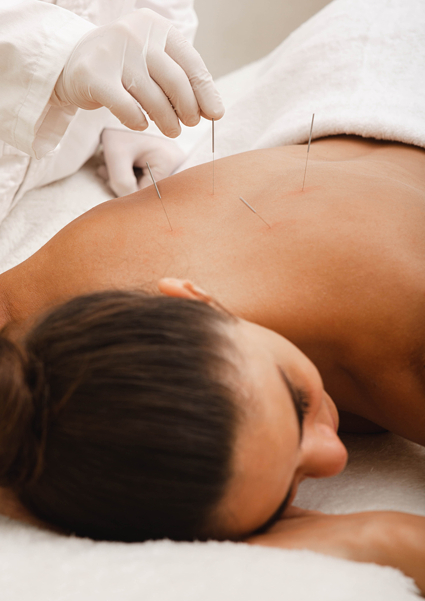 Séance d’acupuncture avec insertion d’aiguilles sur le dos d’un patient en cabinet professionnel. Situation liée à l’assurance responsabilité civile des praticiens en médecines alternatives au Québec.